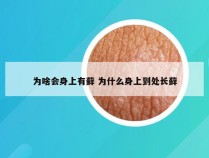 为啥会身上有藓 为什么身上到处长藓