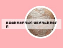 银屑病长期用药可以吗 银屑病可以长期吃的药