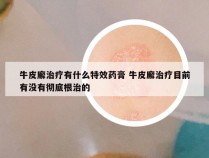 牛皮廨治疗有什么特效药膏 牛皮廨治疗目前有没有彻底根治的