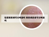 轻度银屑病可以喝酒吗 银屑病患者可以喝酒吗