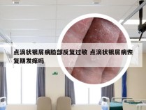 点滴状银屑病脸部反复过敏 点滴状银屑病恢复期发痒吗