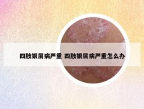 四肢银屑病严重 四肢银屑病严重怎么办