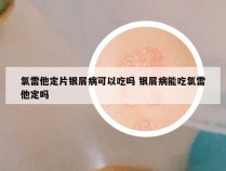 氯雷他定片银屑病可以吃吗 银屑病能吃氯雷他定吗