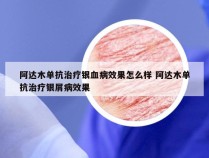 阿达木单抗治疗银血病效果怎么样 阿达木单抗治疗银屑病效果