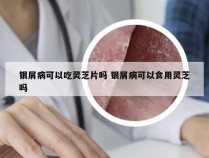 银屑病可以吃灵芝片吗 银屑病可以食用灵芝吗