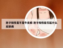 孢子阳性是不是牛皮癣 孢子阳性能引起什么皮肤病