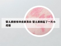 婴儿肩膀有块皮肤发白 婴儿肩膀起了一片小疙瘩