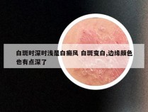 白斑时深时浅是白癜风 白斑变白,边缘颜色也有点深了