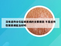 没有遗传会引起银屑病的主要原因 不是遗传性银屑病能治好吗