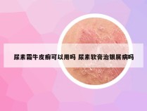 尿素霜牛皮癣可以用吗 尿素软膏治银屑病吗