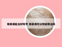 银屑病能治好吗专 银屑病可以彻底根治吗