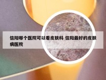 信阳哪个医院可以看皮肤科 信阳最好的皮肤病医院