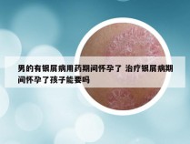 男的有银屑病用药期间怀孕了 治疗银屑病期间怀孕了孩子能要吗