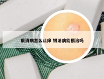 银消病怎么止痒 银消病能根治吗