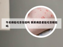 牛皮癣能吃杏包菇吗 银屑病患者能吃杏鲍菇吗