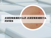 点滴型银屑病吃什么药 点滴型银屑病擦什么药好得快