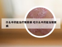 什么中药能治疗银屑病 吃什么中药能治银屑病