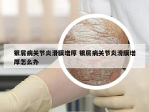 银屑病关节炎滑膜增厚 银屑病关节炎滑膜增厚怎么办