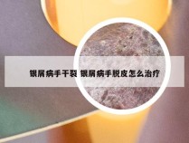 银屑病手干裂 银屑病手脱皮怎么治疗