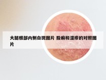 大腿根部内侧白斑图片 股癣和湿疹的对照图片