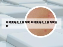 眼睛黑瞳孔上有白斑 眼睛黑瞳孔上有白斑图片