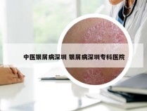 中医银屑病深圳 银屑病深圳专科医院