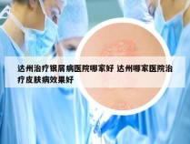 达州治疗银屑病医院哪家好 达州哪家医院治疗皮肤病效果好