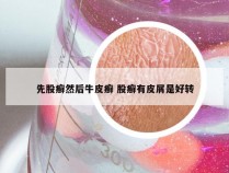 先股癣然后牛皮癣 股癣有皮屑是好转