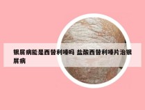 银屑病能是西替利嗪吗 盐酸西替利嗪片治银屑病