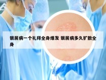 银屑病一个礼拜全身爆发 银屑病多久扩散全身