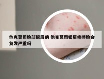 他克莫司脸部银屑病 他克莫司银屑病擦脸会复发严重吗