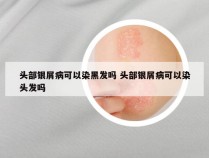 头部银屑病可以染黑发吗 头部银屑病可以染头发吗