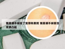 银屑病不掉皮了变得和黑斑 银屑病不掉屑但皮肤凸起