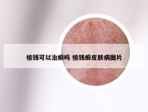 榆钱可以治癣吗 榆钱癣皮肤病图片