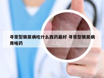 寻常型银屑病吃什么西药最好 寻常型银屑病用啥药