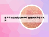 全身有银屑病能治断跟吗 全身银屑病吃什么药