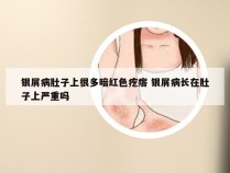 银屑病肚子上很多暗红色疙瘩 银屑病长在肚子上严重吗