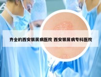 齐全的西安银屑病医院 西安银屑病专科医院