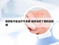 刮痧能不能治疗牛皮癣 刮痧治好了我的皮肤病