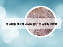 牛皮屑有没有中药可以治疗 中药治疗牛皮廨