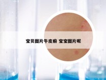 宝贝图片牛皮癣 宝宝图片呢