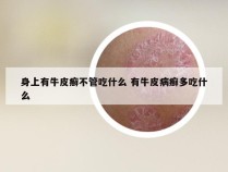 身上有牛皮癣不管吃什么 有牛皮病癣多吃什么