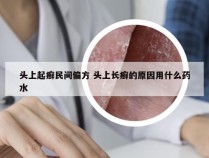 头上起癣民间偏方 头上长癣的原因用什么药水