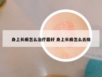 身上长癣怎么治疗最好 身上长癣怎么去除