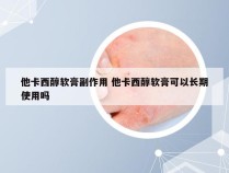 他卡西醇软膏副作用 他卡西醇软膏可以长期使用吗