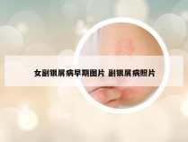 女副银屑病早期图片 副银屑病照片