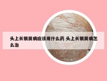 头上长银屑病应该用什么药 头上长银屑病怎么治