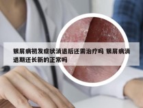 银屑病初发症状消退后还需治疗吗 银屑病消退期还长新的正常吗