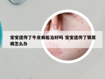 宝宝遗传了牛皮癣能治好吗 宝宝遗传了银屑病怎么办