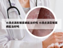 小孩点滴形银屑病能治好吗 小孩点滴型银屑病能治好吗